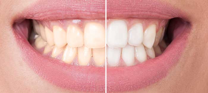 Teeth Whitening